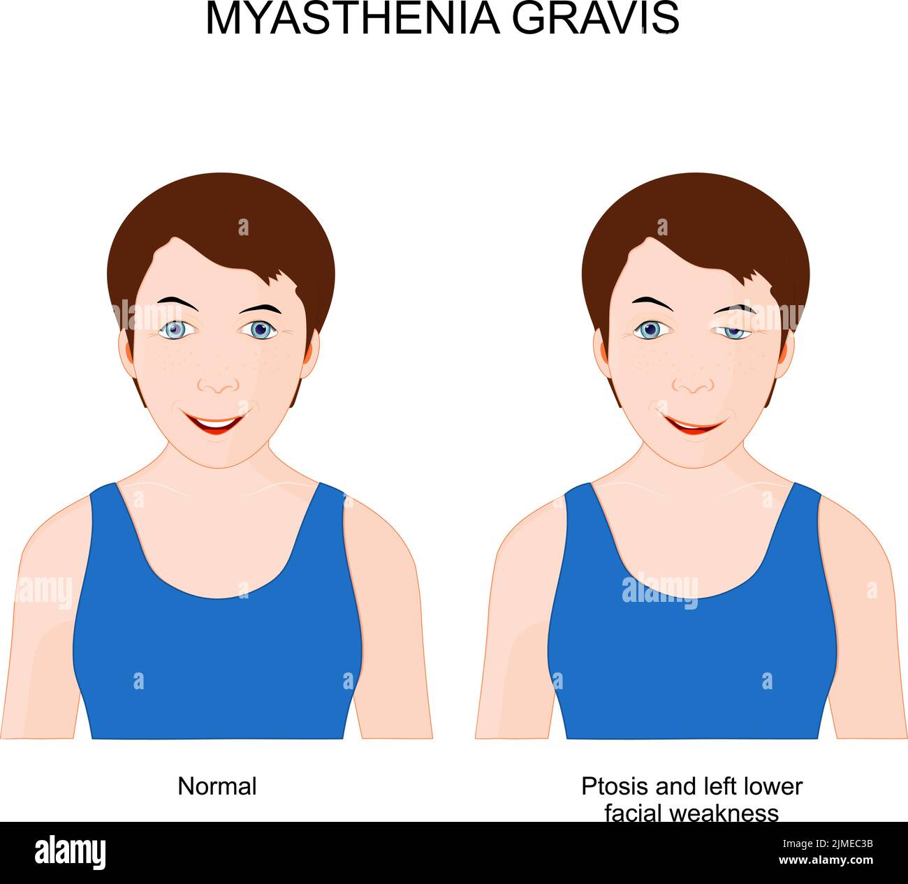 Myasthenia gravis. Girl with neuromuscular disease. patient with ptosis and Left lower facial weakness. Symptoms of Autoimmune disease. Vector poster Stock Vector