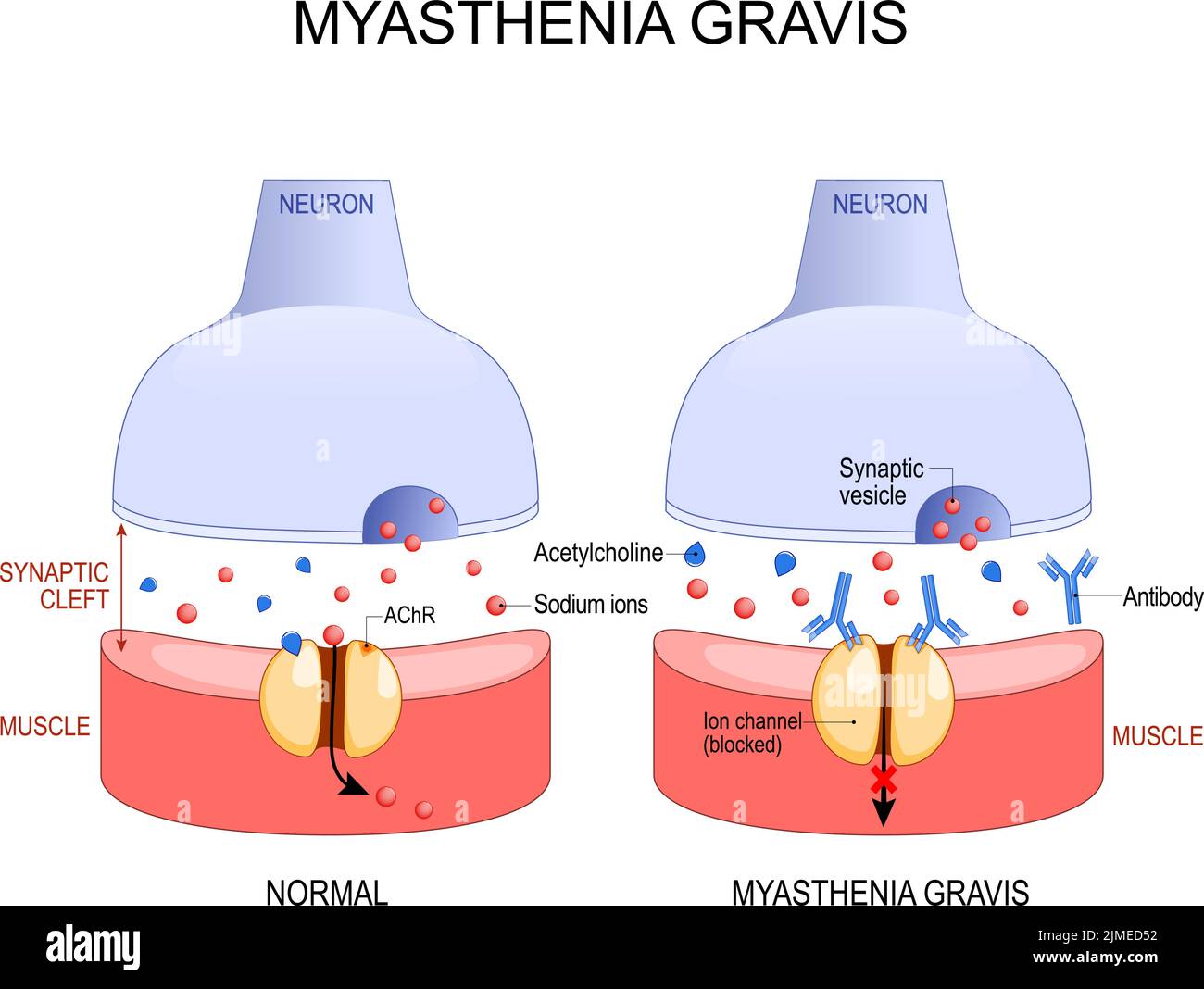 Myasthenia gravis. Autoimmune disease. space between neuron and muscle. In myasthenia gravis, abnormal antibodies prevent acetylcholine from binding, Stock Vector