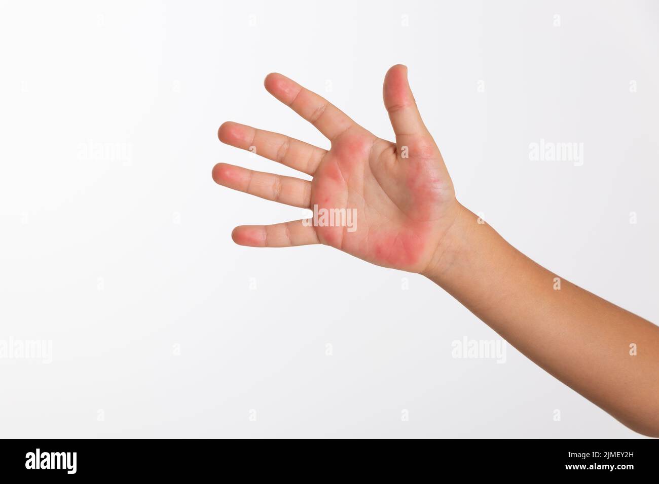allergic eczema on a child's hand Stock Photo Alamy