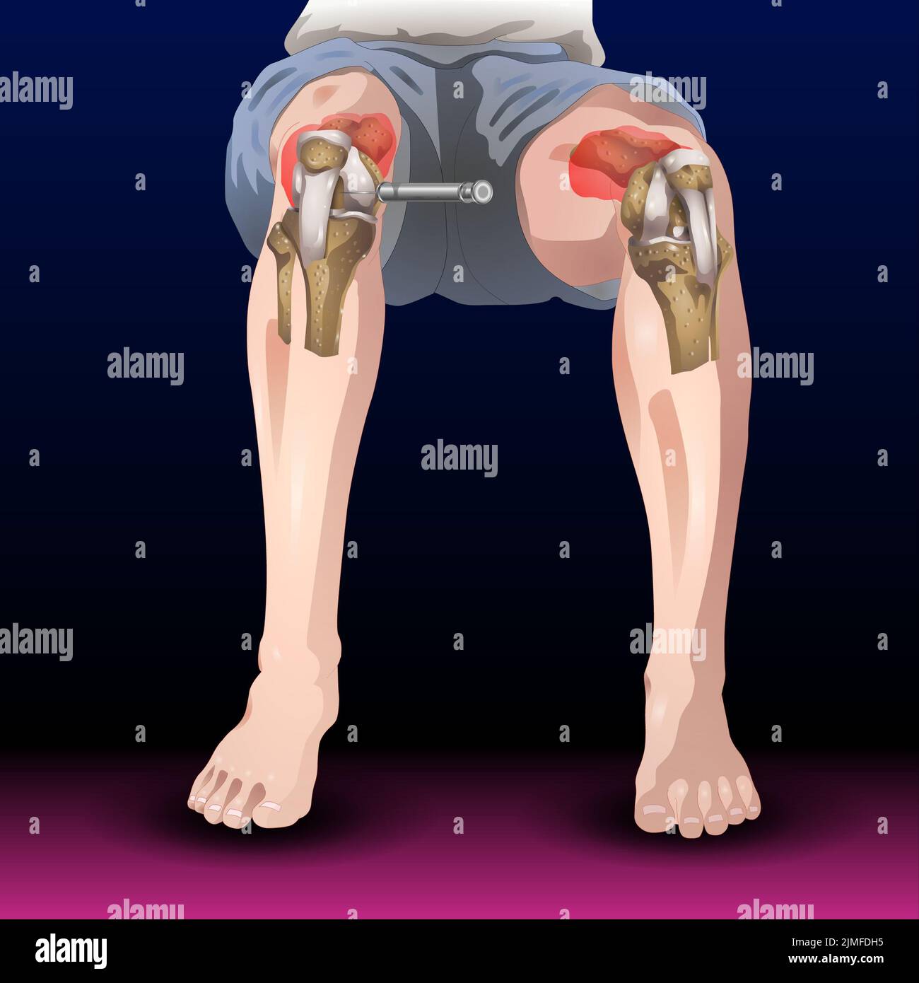 Bones Pain, Injury and Inflammation, Knee Joint Pain Silhouette Icon Ache of Knee, Leg Skeleton, Arthritis, Osteoporosis and Bones Joint, Illustration Stock Photo