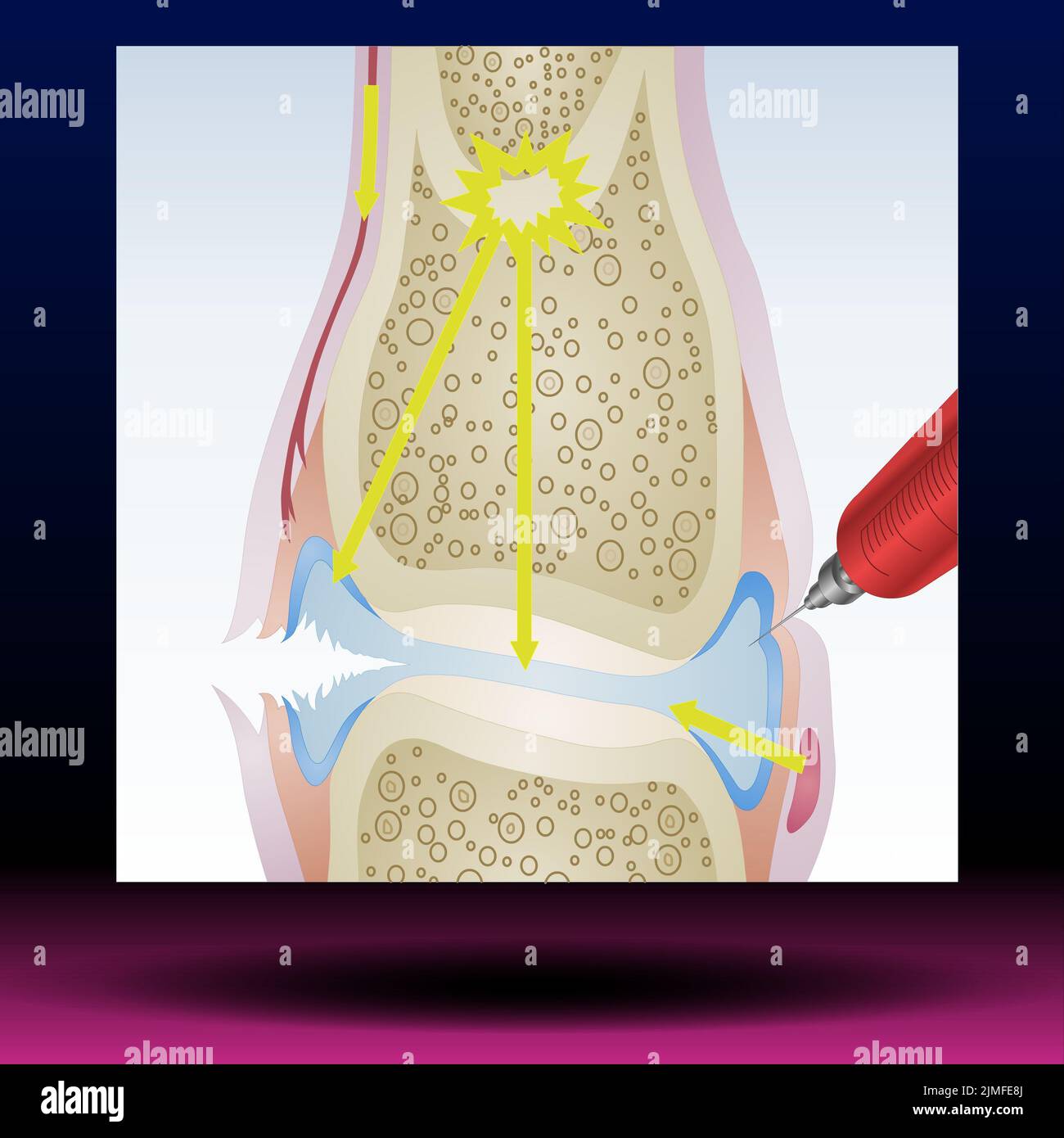 Rheumatoid Arthritis RA that usually affects knees. the auto immune disease. Vector Illustration Stock Photo