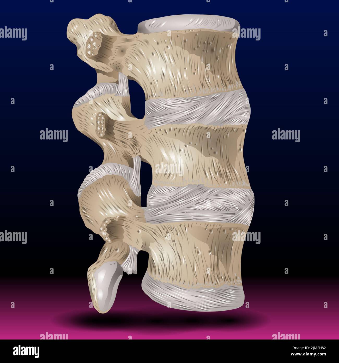 Spondylitis Stock Photo