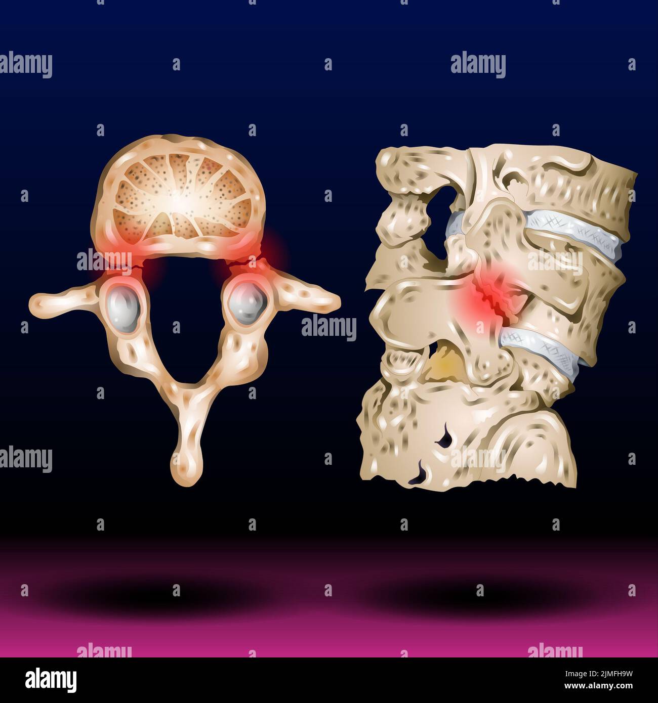 Spondylolisthesis (Stress Fractures) Stock Photo