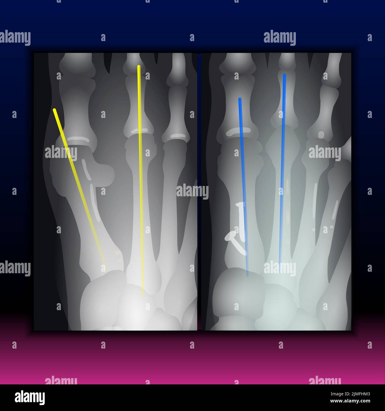 X-ray of Foot Claw Stock Photo