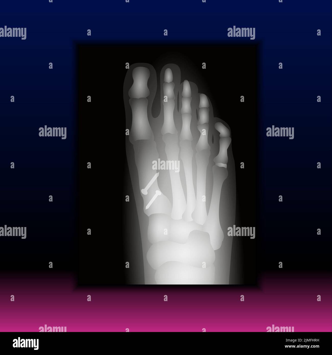 x-ray-of-foot-stock-photo-alamy