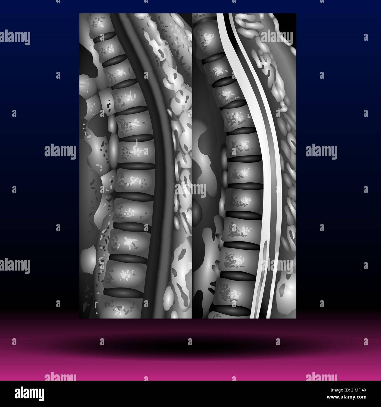 X-ray Myelography Stock Photo