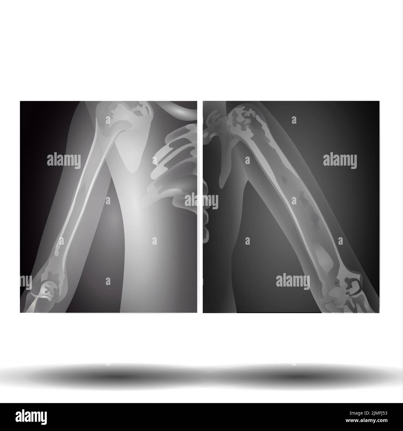 XRay of Hand Upper Limb Stock Photo Alamy