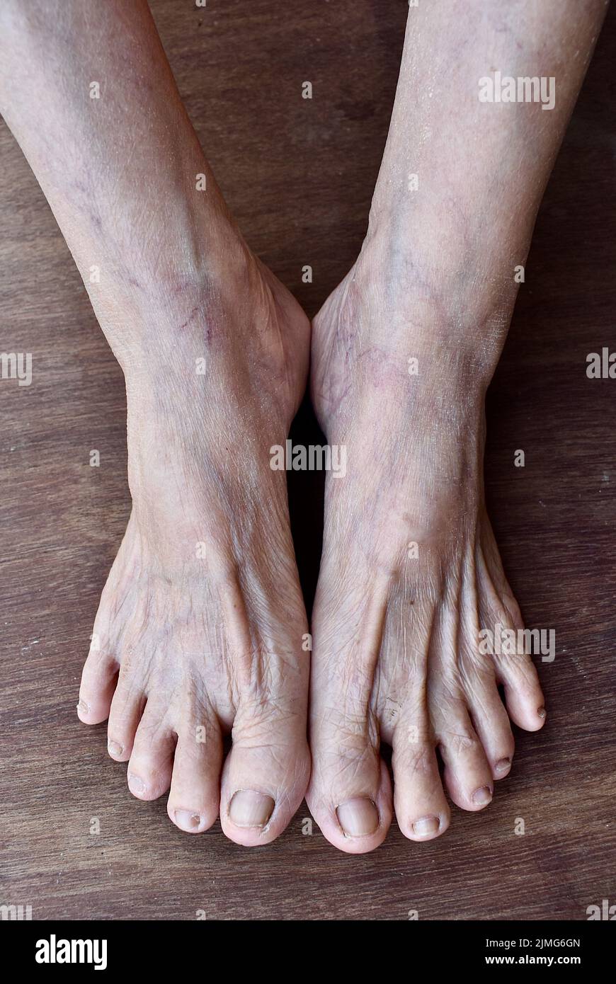 Skin wrinkles and prominent veins visible through the thin foot skin of