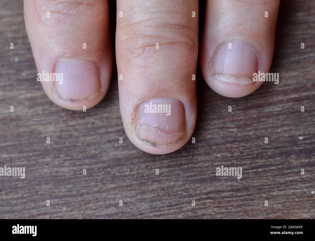 What vitamin are you lacking when your nails split? - Quora