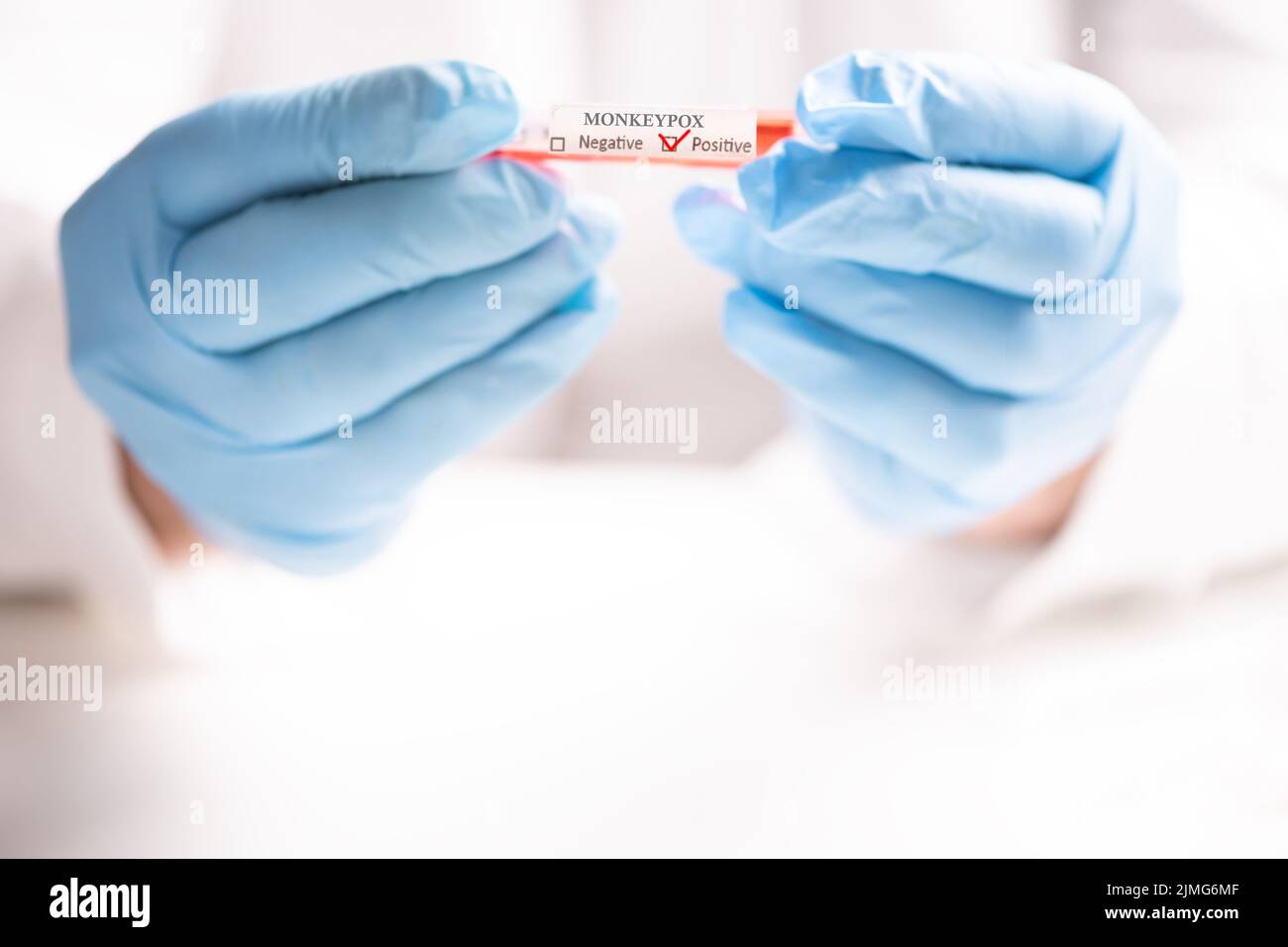 A Doctor with a blood sample in a tube diagnosed with Monkeypox MPXV ...