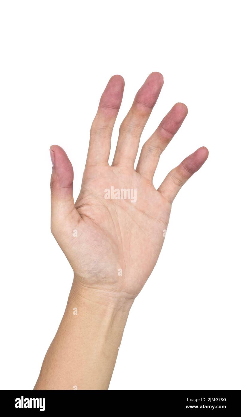 Nail blanch test: MedlinePlus Medical Encyclopedia Image