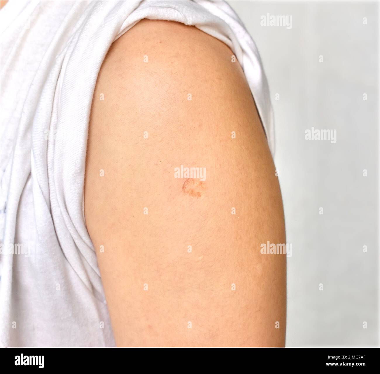 BCG or TB vaccine scar mark at the arm of Southeast Asian man. Stock Photo