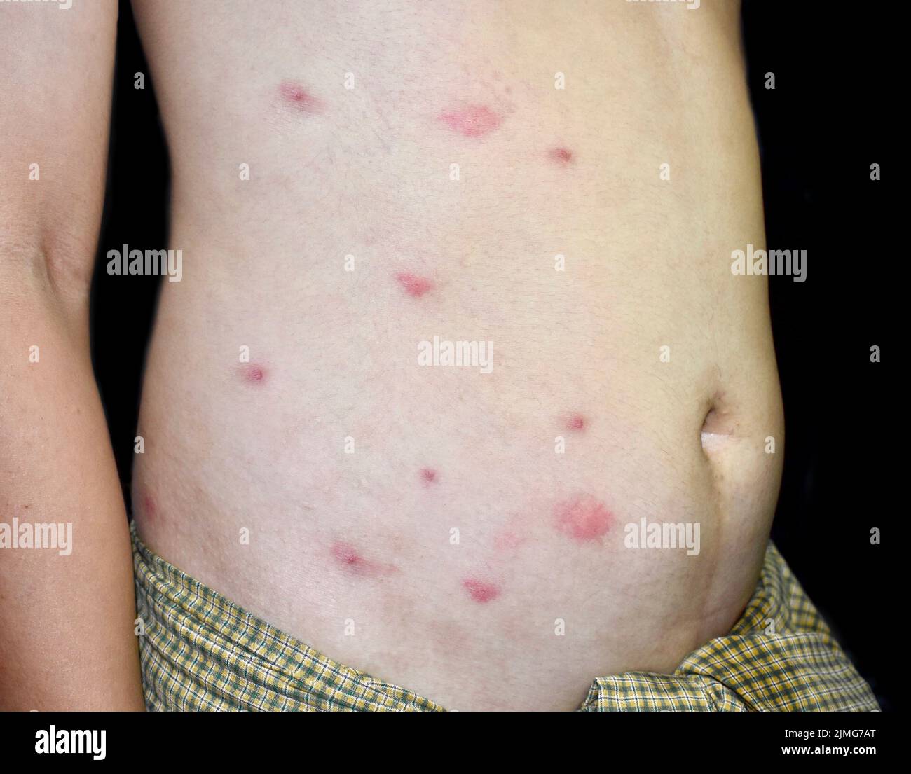 Multiple itchy mosquito or insect bite wheals; red spots on trunk of Southeast Asian, Chinese adult young man. Isolated on black background. Stock Photo