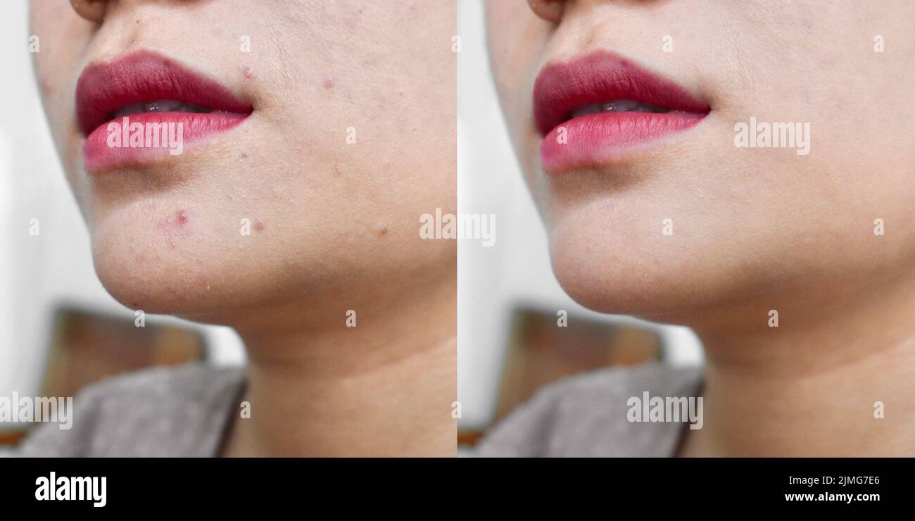 Acne, black spots and scars on face of Asian young woman. Before and after treatment Stock Photo