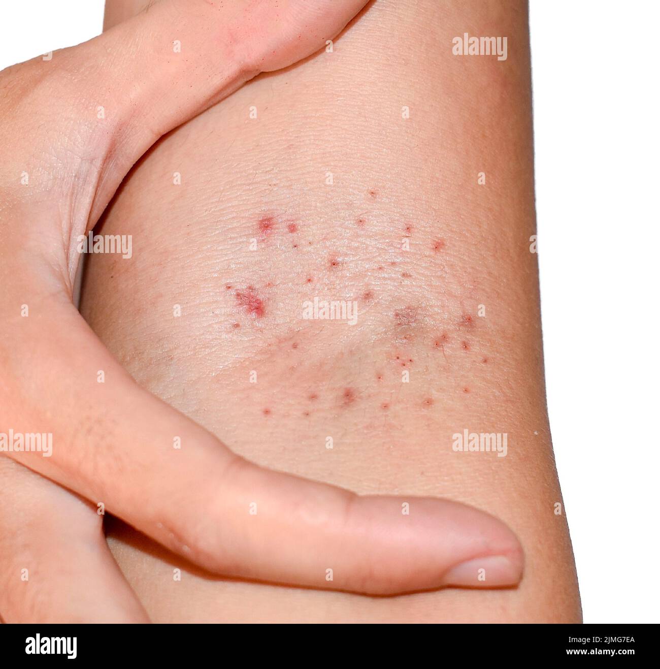 Multiple red spots in cubital fossa showing that Hess’s test positive. Dengue hemorrhagic fever. Stock Photo