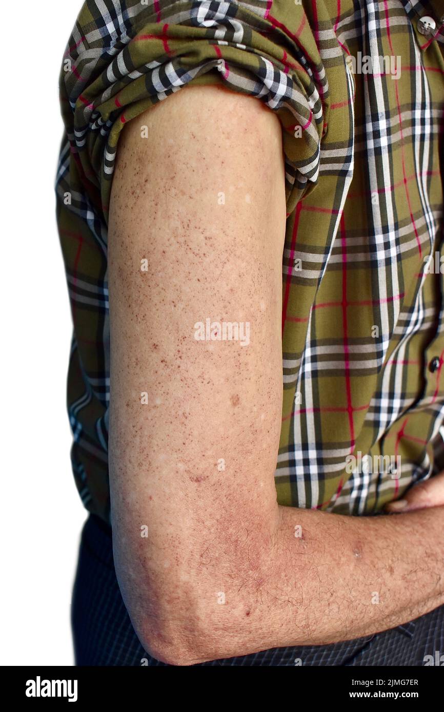 Age spots and white patches on arm of Asian elder man. These age spots are brown, gray, or black