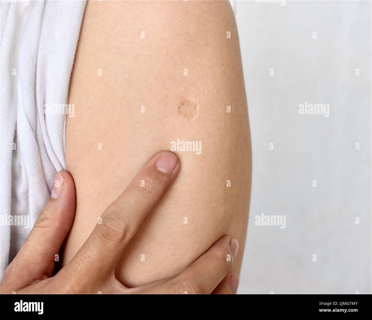 BCG or TB vaccine scar mark at the arm of Southeast Asian man. Stock Photo