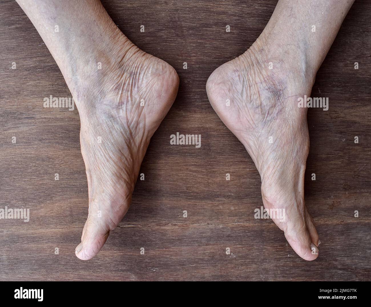 Skin wrinkles and prominent veins visible through the thin foot skin of
