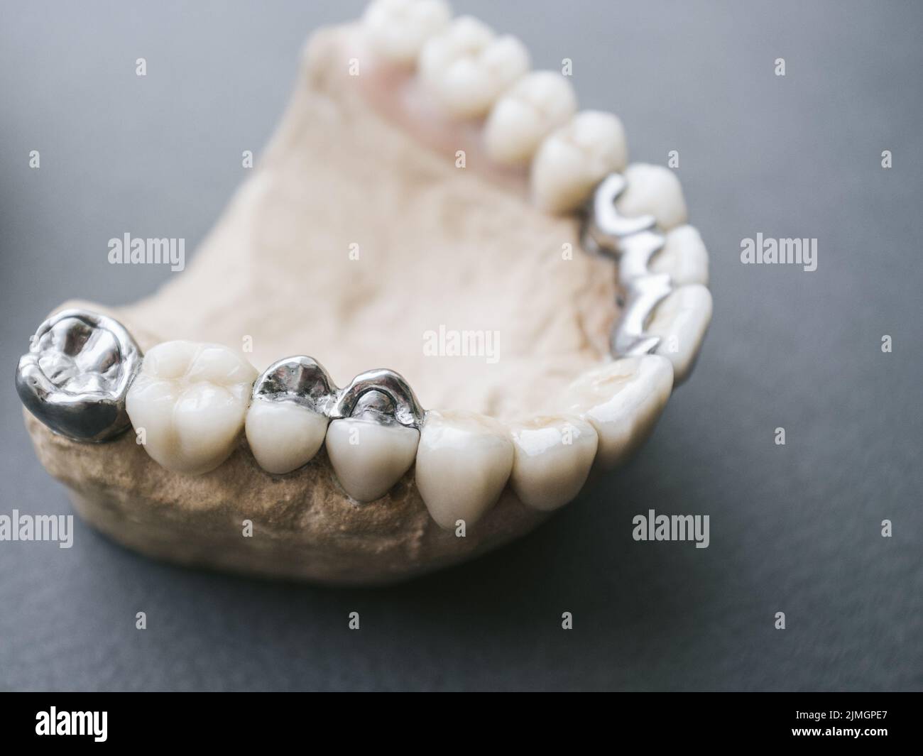 jaw layout ceramic metal denture dental prosthesis Stock Photo Alamy
