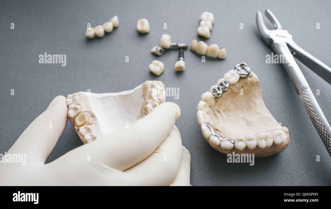 Orthodontic prosthetics gypsym jaw denture forceps Stock Photo Alamy
