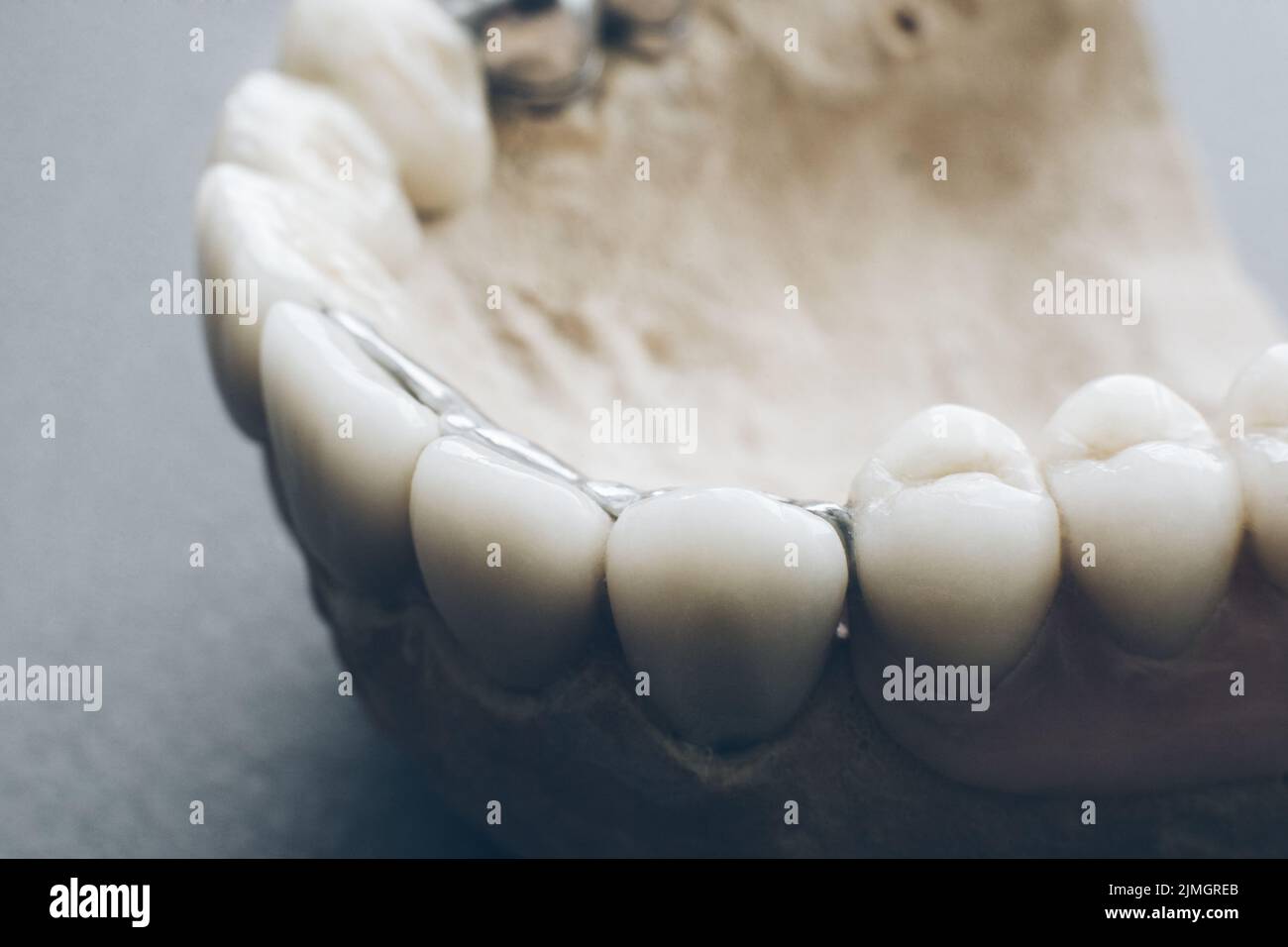 orthodontics prosthetics dental implants gypsum Stock Photo Alamy