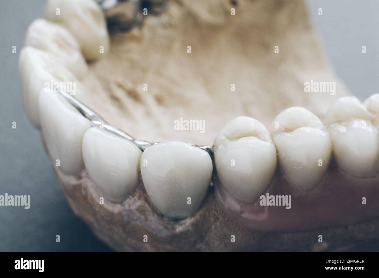 dentistry implantation jaw mold artificial denture Stock Photo Alamy