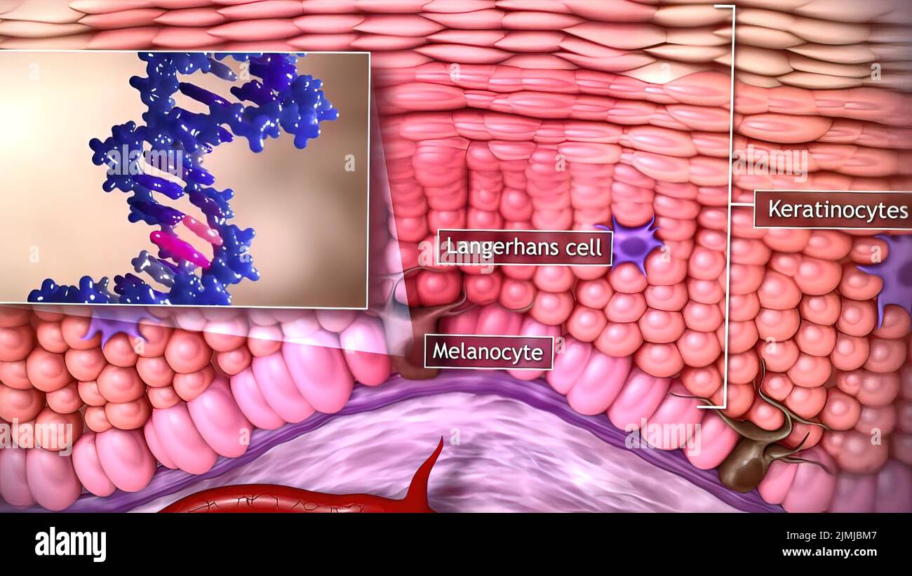 Human squamous cell carcinoma of the skin hi-res stock photography and ...