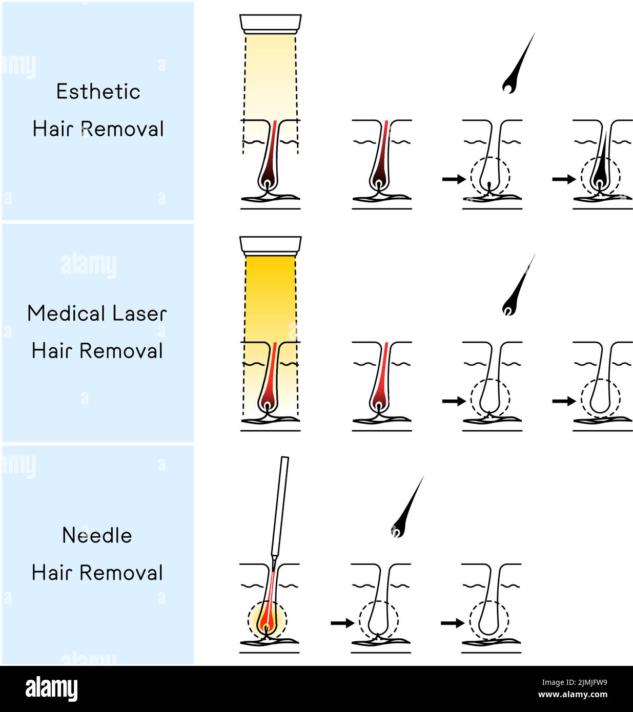 Image of Hair Removal, Esthetic Hair Removal, Medical Laser Hair