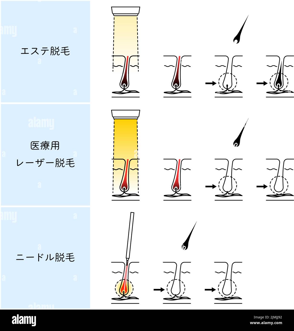 Image of Hair Removal, Esthetic Hair Removal, Medical Laser Hair