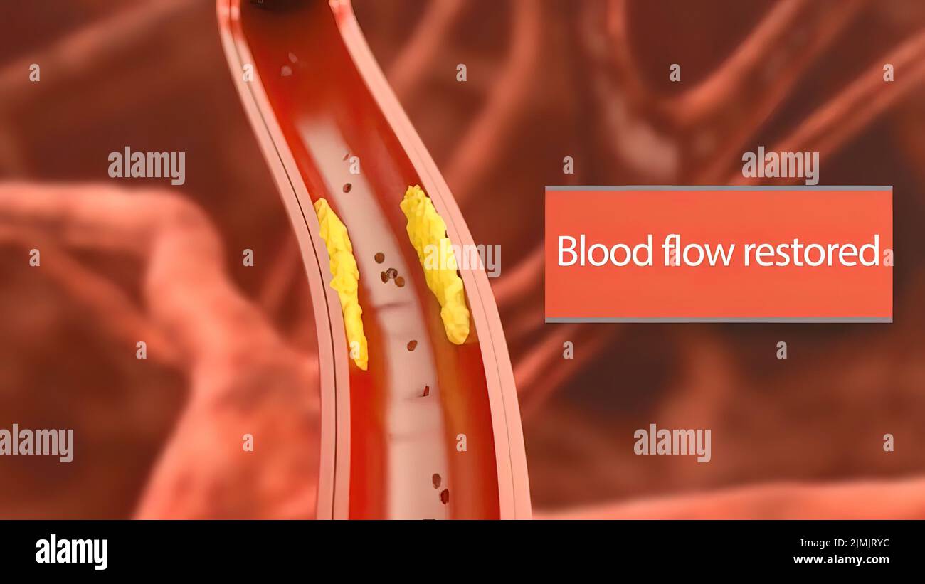 Atherosclerosis in an artery hires stock photography and images Alamy
