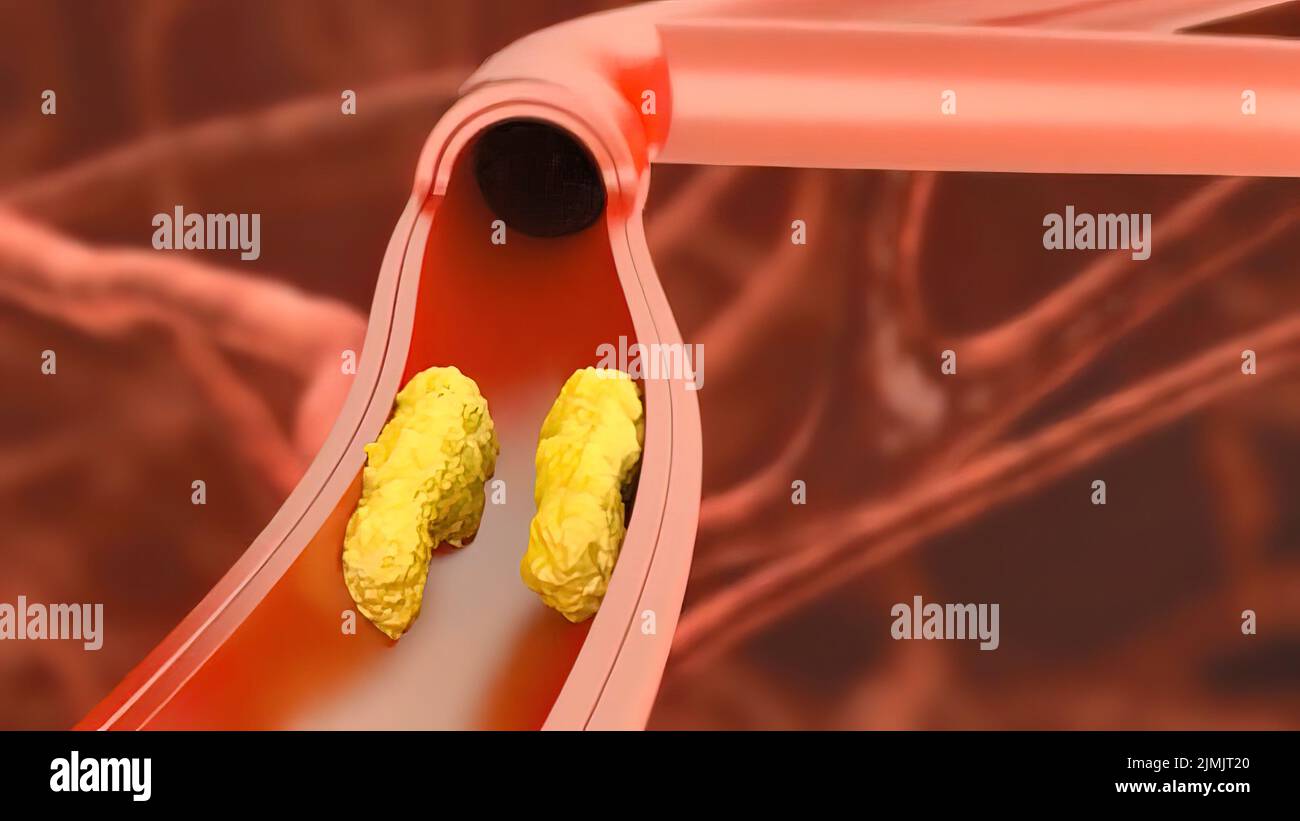 Plaque buildup arteries hires stock photography and images Alamy