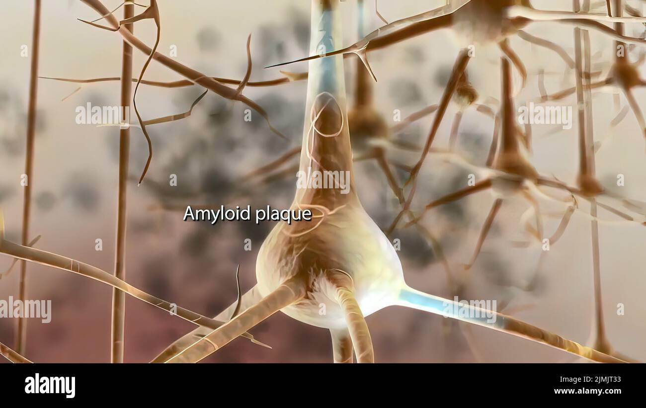 Alzheimer's disease plaques hires stock photography and images Alamy