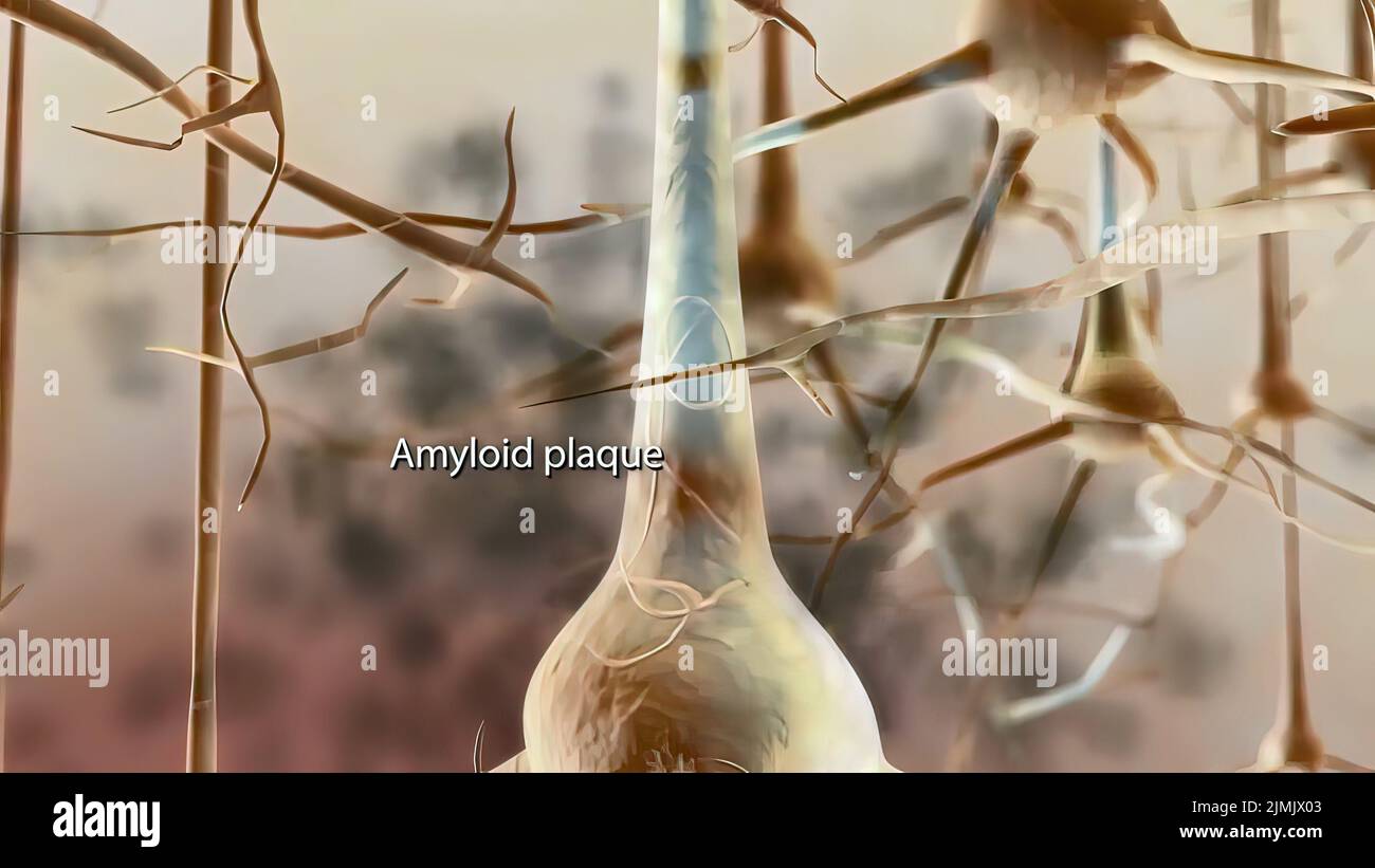 Amyloid Plaques. The beta3D illustration protein involved in Alzheimer's disease Stock Photo
