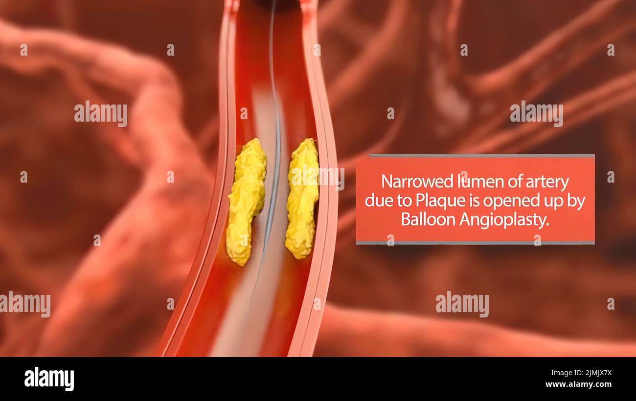 Artery plaque lining hires stock photography and images Alamy