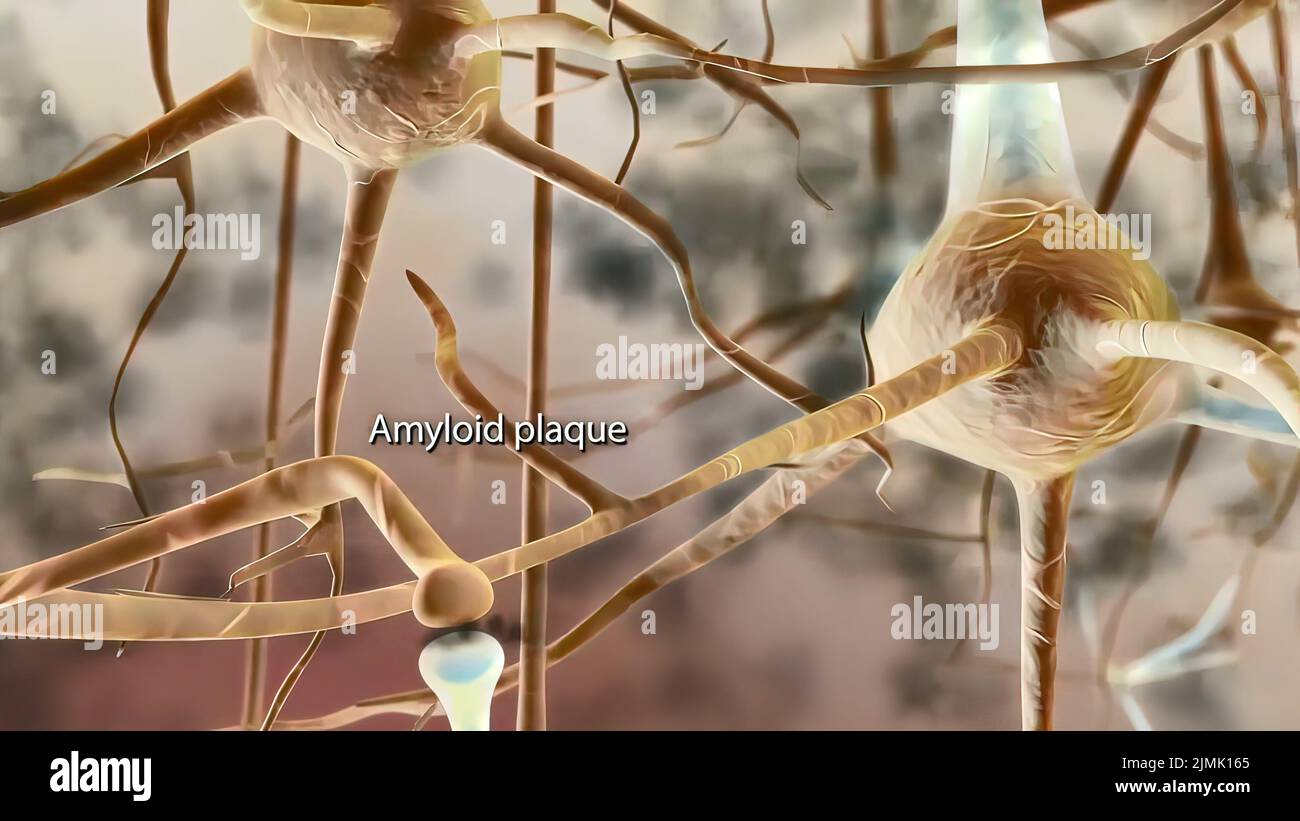 Alzheimer's disease plaques hires stock photography and images Alamy