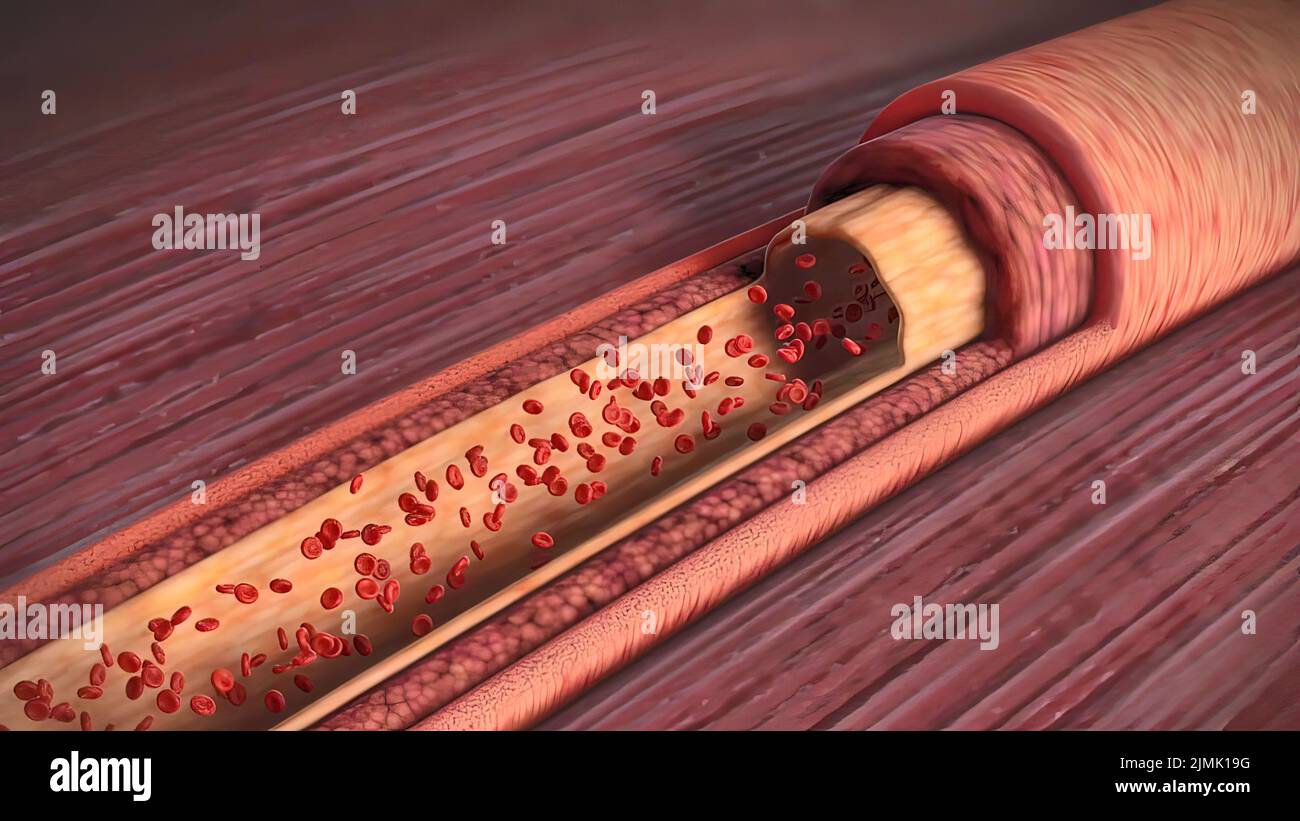 Cholesterol infographic hires stock photography and images Alamy