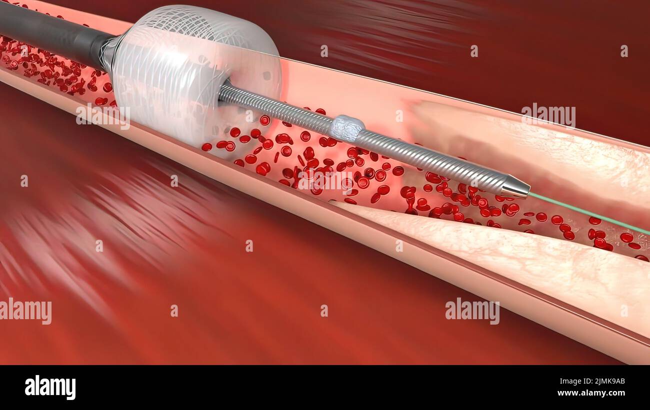 Vascular occlusion is a blockage of a blood vessel, usually with a clot