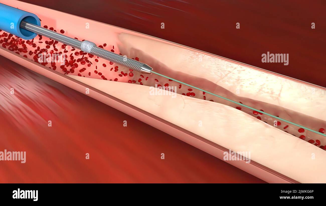 Vessel occlusion hires stock photography and images Alamy