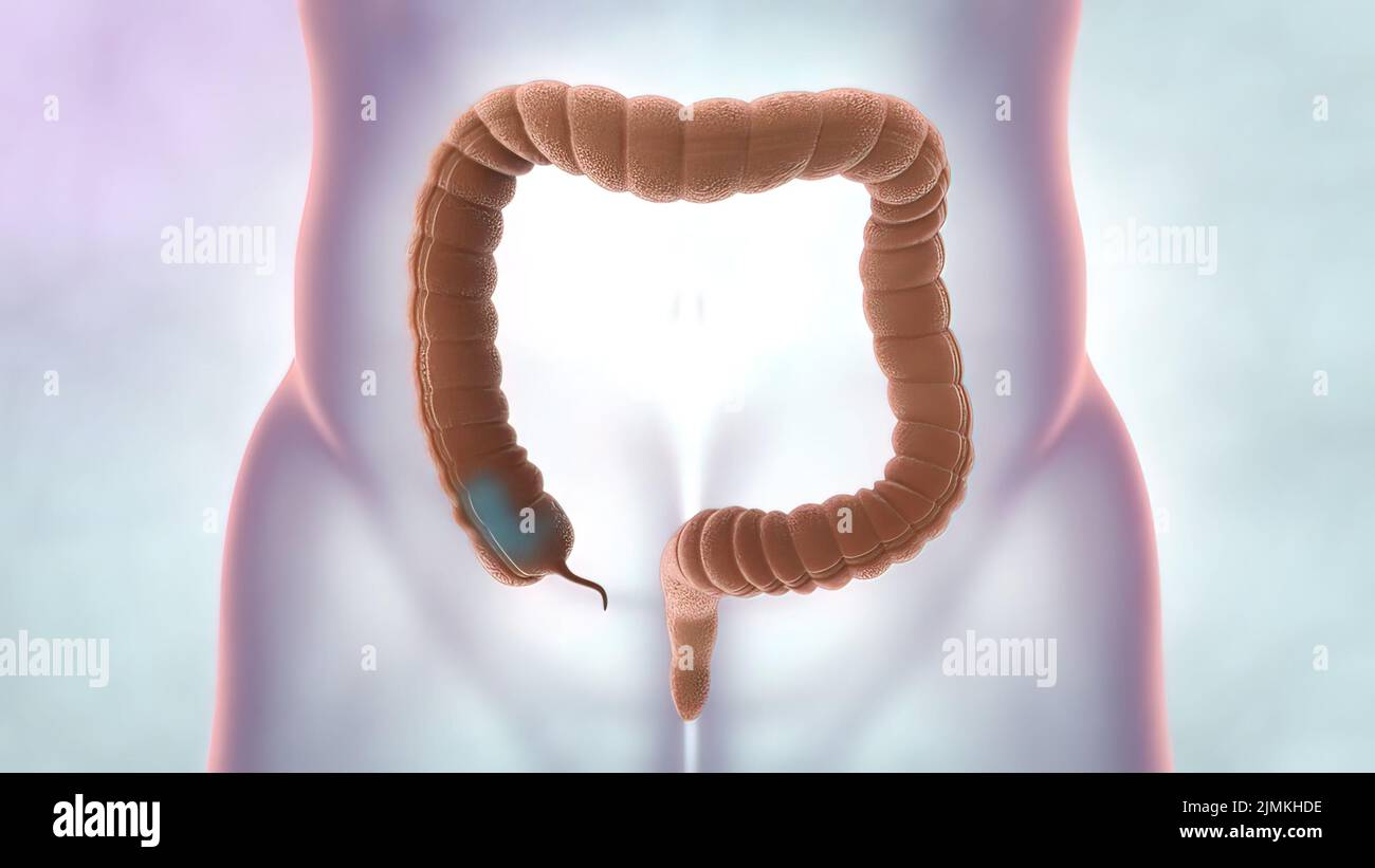 Intestin colon hi-res stock photography and images - Alamy