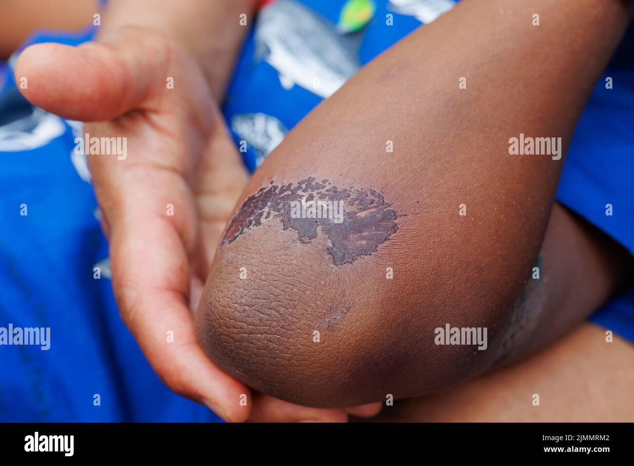 Large, healing scab on the arm of a young boy of african ehtnicity Stock Photo