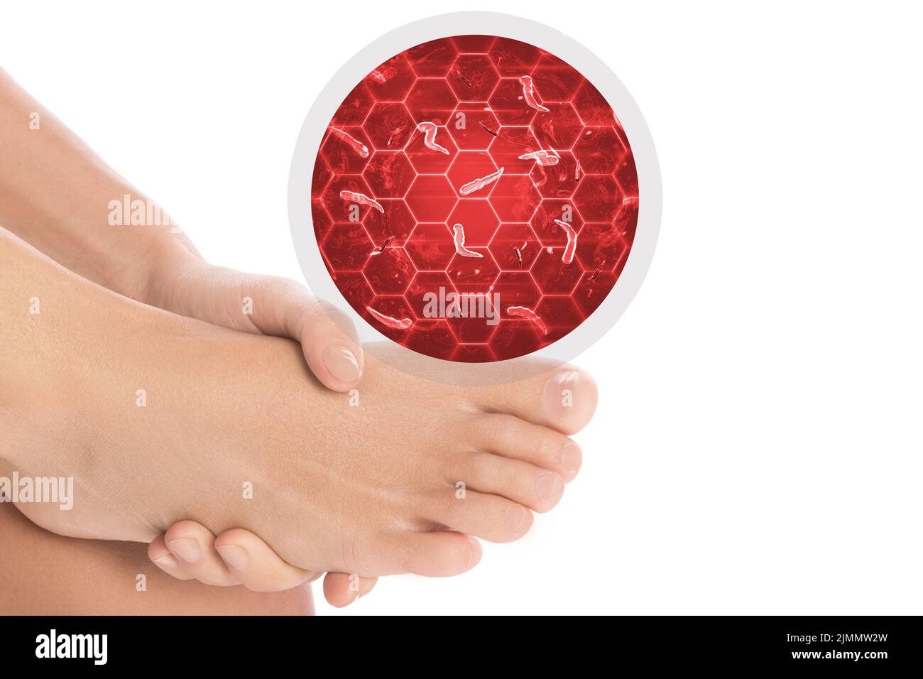 Feet affected by fungus on white background Stock Photo