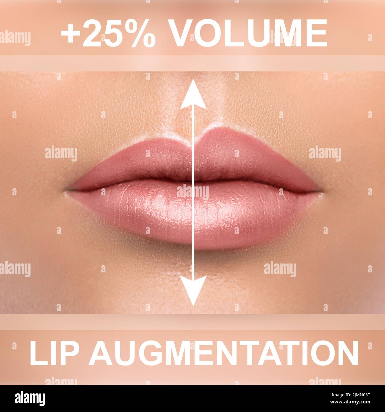 Comparison of female lips after augmentation with filler injections