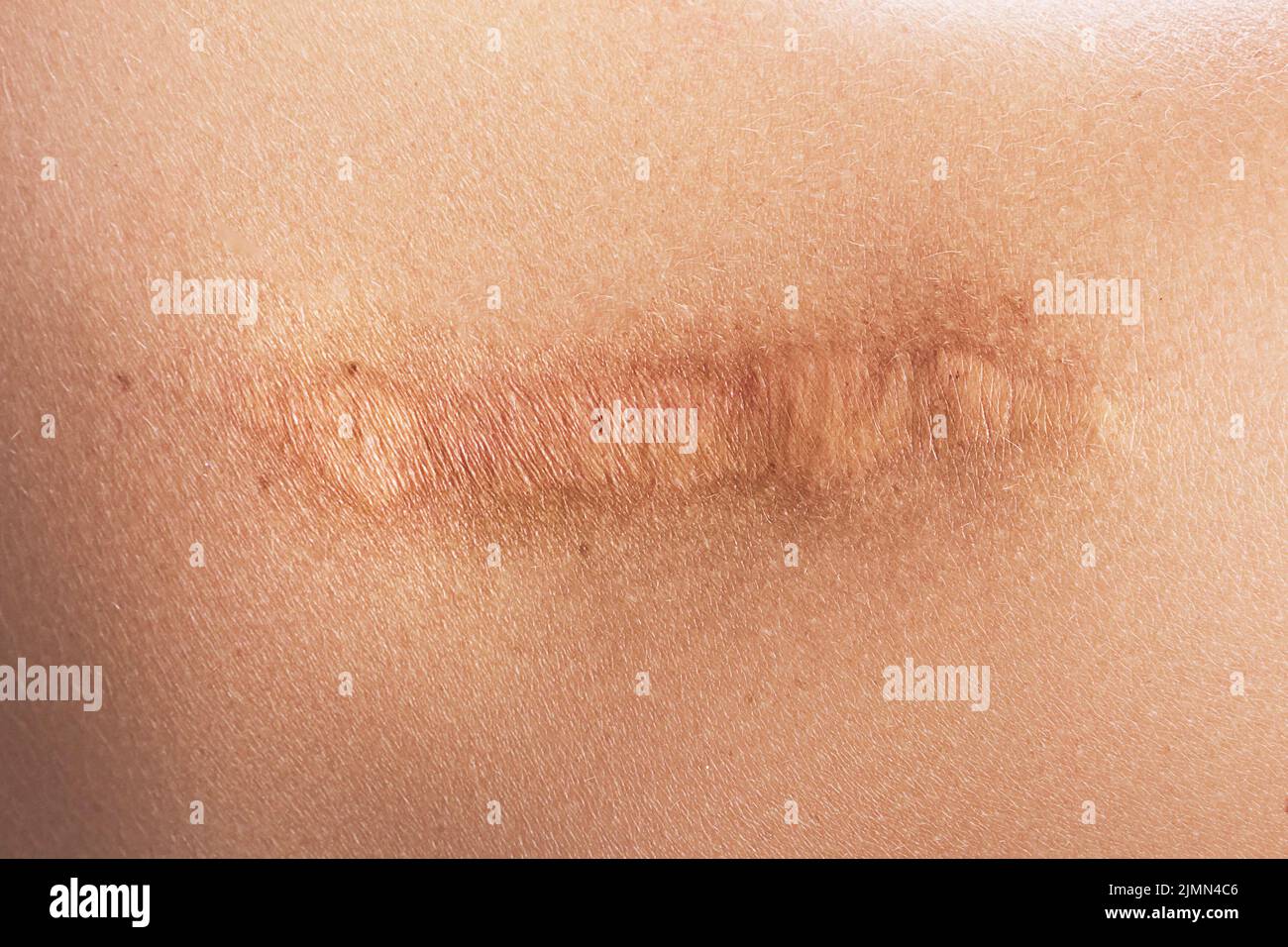 Female shoulder with a scar after surgery Stock Photo