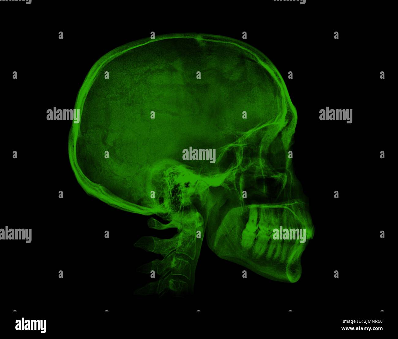 Human skull. Green X-ray image on black background Stock Photo - Alamy