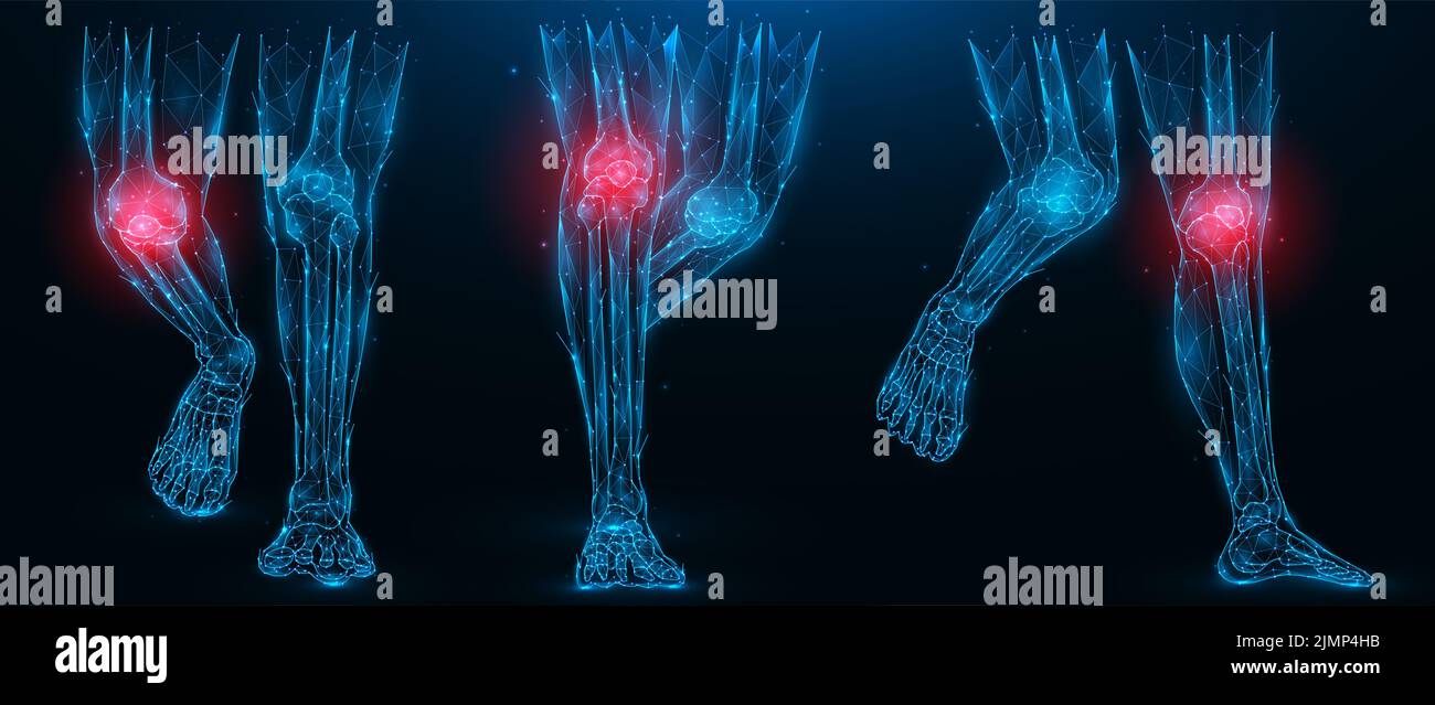 Polygonal vector illustration of human legs, inflammatory disease of the knee joint concept. Low poly art lower limbs on a dark Stock Photo