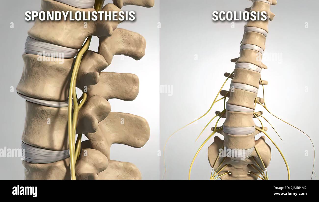 Lumbar disc hires stock photography and images Alamy
