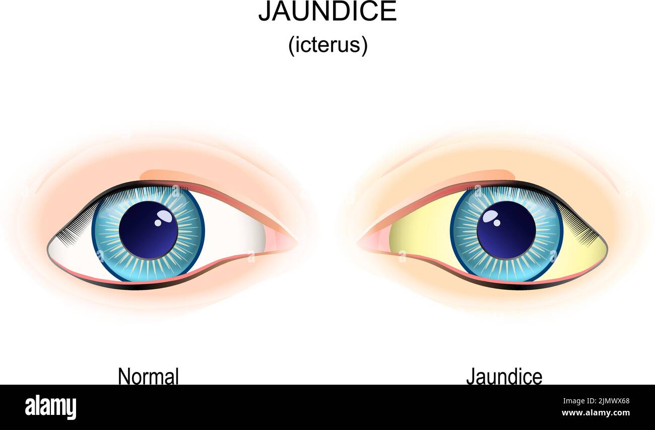 Jaundice. Comparison and difference of normal eye, and eye with icterus symptom. yellowish or greenish pigmentation of the skin and sclera due to high Stock Vector