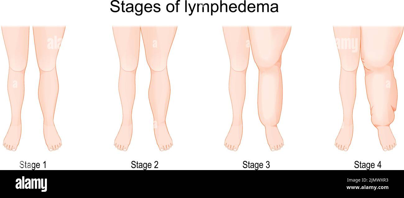 Severity of lower extremity lymphedema in different stages. Vector illustration Stock Vector
