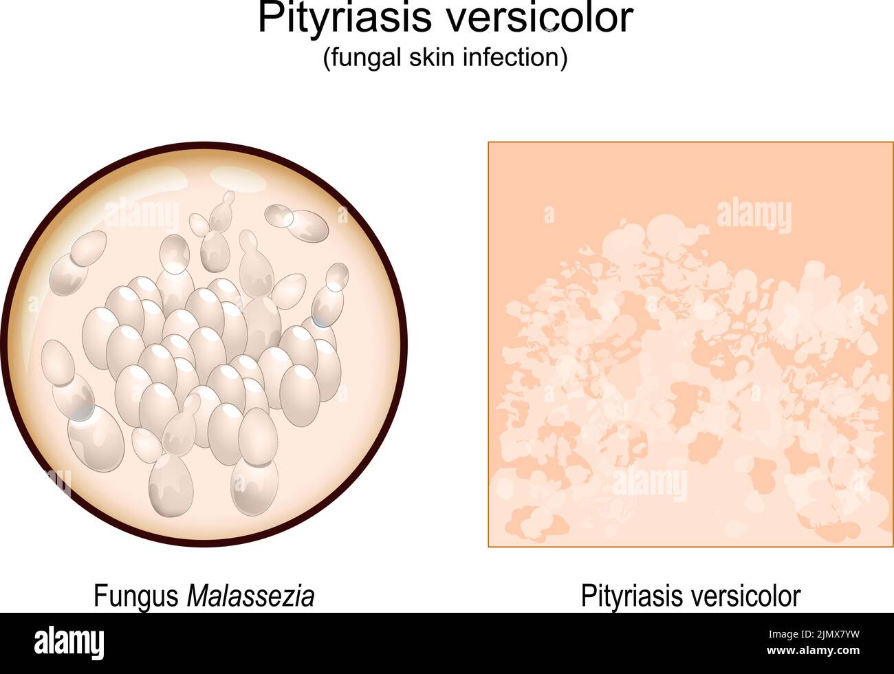 pityriasis versicolor. skin surface with Signs and symptoms of Tinea versicolor. Close-up of a Malassezia fungi that caused skin eruption. vector Stock Vector
