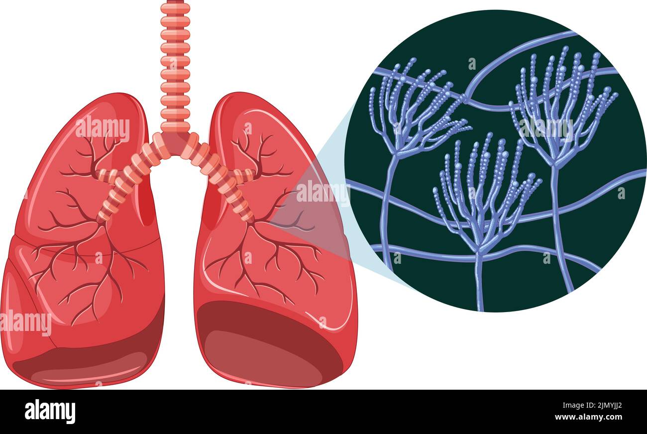 The Mold Spores Grow In Human Lungs Illustration Stock Vector Image 